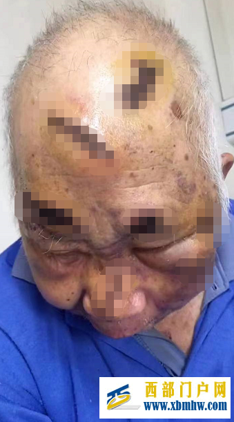 宜宾79岁老人养老院内被打?回应:与另一老人在医院起纷争受伤(图1) 宜宾79岁老人养老院内被打?回应:与另一老人在医院起纷争受伤(图1)